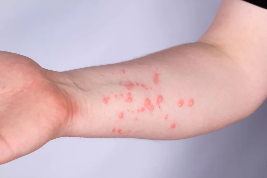 Вирус коксаки распространяется в российских школах: зафиксированы вспышки в четырех регионах