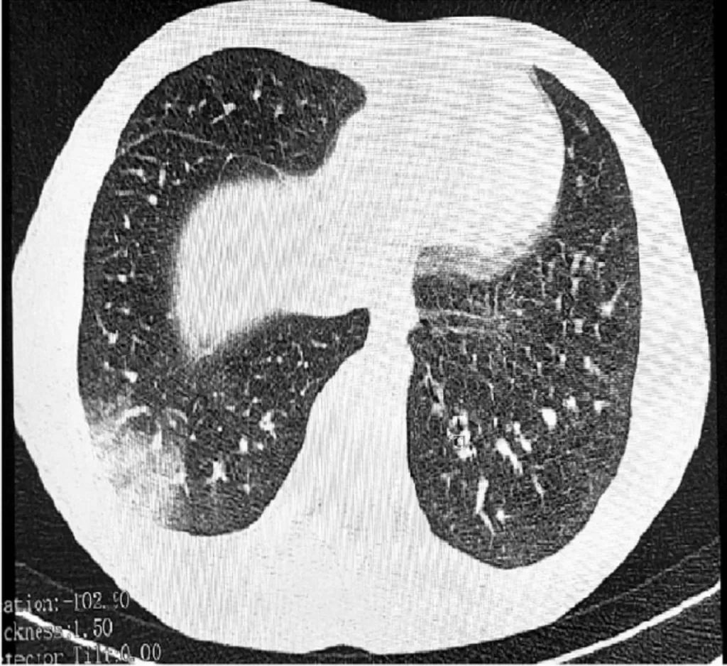 В России обнаружили неизлечимую «болезнь вейперов»