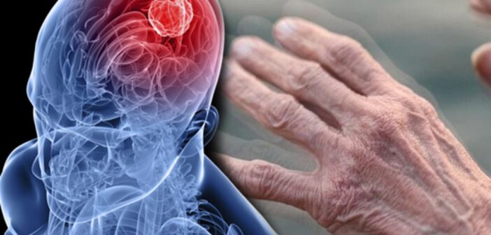 Российская нейросеть научилась находить болезнь Паркинсона до появления симптомов