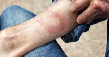 Болезнь Лайма у Джастина Тимберлейка: симптомы, лечение и риски заражения в России