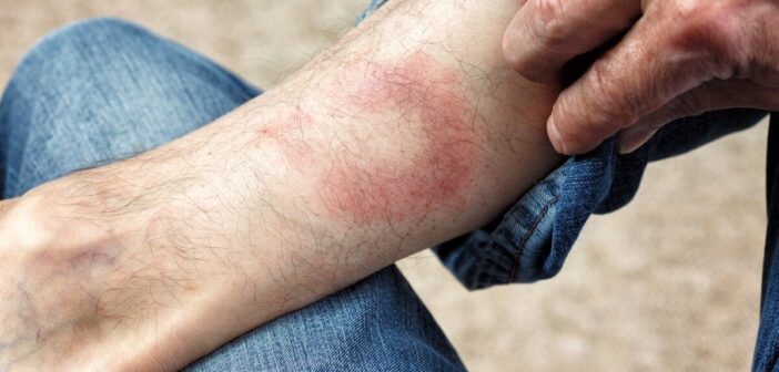 Болезнь Лайма у Джастина Тимберлейка: симптомы, лечение и риски заражения в России