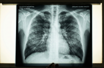 В России фиксируют вспышку агрессивной пневмонии неизвестного происхождения