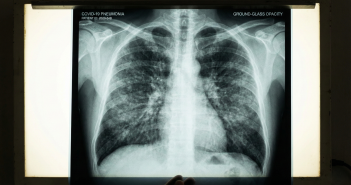 В России фиксируют вспышку агрессивной пневмонии неизвестного происхождения