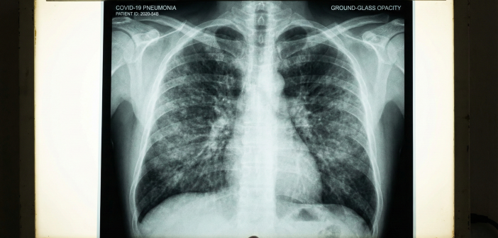 В России фиксируют вспышку агрессивной пневмонии неизвестного происхождения