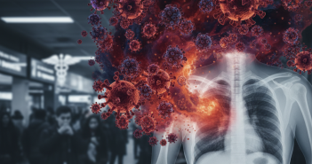 Внебольничная пневмония наступает: Минздрав России предупреждает о росте тяжелых случаев